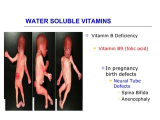 WATER SOLUBLE VITAMINS

                  Vitamin B Deficiency

                      Vitamin B9 (folic acid)



                           In pregnancy
                            birth defects
                                Neural Tube
                                 Defects
                                   Spina Bifida

                                   Anencephaly
 