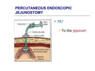 PERCUTANEOUS ENDOSCOPIC
JEJUNOSTOMY

                  PEJ

                      To the jejunum
 