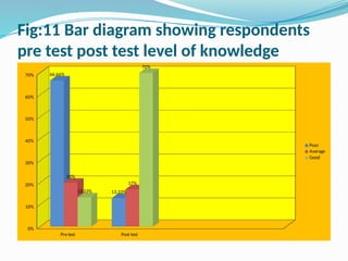 Fig:11 Bar diagram showing respondents
pre test post test level of knowledge
Pre test Post test
0%
10%
20%
30%
40%
50%
60%
70% 66.66%
13.33%
20%
17%
13.33%
70%
Poor
Average
Good
 