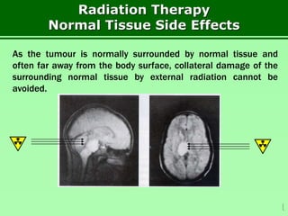 Radiation Therapy – External
As the tumour is normally surrounded by normal tissue and
often far away from the body surface, collateral damage of the
surrounding normal tissue by external radiation cannot be
avoided.

Radiation Therapy
Normal Tissue Side Effects
 