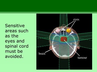 Sensitive
areas such
as the
eyes and
spinal cord
must be
avoided.
brain
eyes
tumour
 
