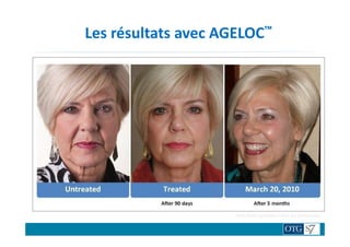 Les résultats avec AGELOC™
TRAITENON TRAITE
Après 90 jpurs de traitement
Résultats variables selon les personnes.
 