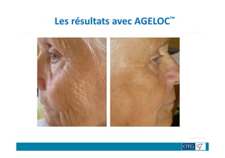 Les résultats avec AGELOC™
TRAITENON TRAITE
Résultats variables selon les personnes.
 