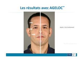 Les résultats avec AGELOC™
TRAITENON TRAITE
Après 1 de traitement
Résultats variables selon le
 