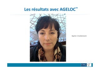 Les résultats avec AGELOC™
TRAITENON TRAITE
Après 1 traitement
Résultats variables selon les personnes.
 
