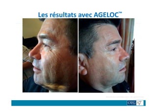 Les résultats avec AGELOC™
TRAITENON TRAITE
Après 1 traitement
Résultats variables selon les personnes.
 