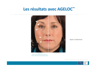 Les résultats avec AGELOC™
TRAITENON TRAITE
Après 1 traitement
Résultats variables selon les personnes.
 