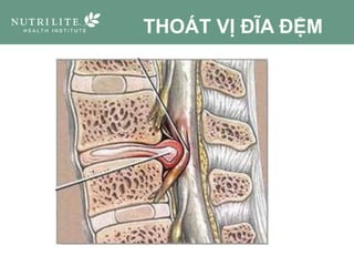 THOÁT VỊ ĐĨA ĐỆM
 