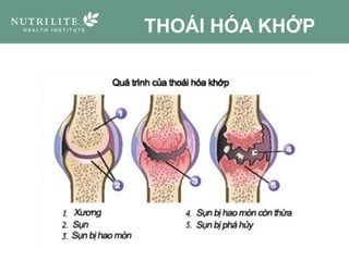 THOÁI HÓA KHỚP
 