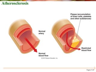 Atherosclerosis
Figure 5.24
 