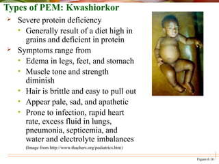 Types of PEM: Kwashiorkor
 Severe protein deficiency
• Generally result of a diet high in
grains and deficient in protein
 Symptoms range from
• Edema in legs, feet, and stomach
• Muscle tone and strength
diminish
• Hair is brittle and easy to pull out
• Appear pale, sad, and apathetic
• Prone to infection, rapid heart
rate, excess fluid in lungs,
pneumonia, septicemia, and
water and electrolyte imbalances
(Image from http://www.thachers.org/pediatrics.htm)
Figure 6.16
 
