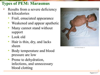 Types of PEM: Marasmus
 Results from a severe deficiency
in kilocalories
• Frail, emaciated appearance
• Weakened and appear apathetic
• Many cannot stand without
support
• Look old
• Hair is thin, dry, and lacks
sheen
• Body temperature and blood
pressure are low
• Prone to dehydration,
infections, and unnecessary
blood clotting
Figure 6.17
 