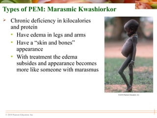 © 2010 Pearson Education, Inc.
Types of PEM: Marasmic Kwashiorkor
 Chronic deficiency in kilocalories
and protein
• Have edema in legs and arms
• Have a “skin and bones”
appearance
• With treatment the edema
subsides and appearance becomes
more like someone with marasmus
 