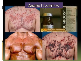 Anabolizantes
 