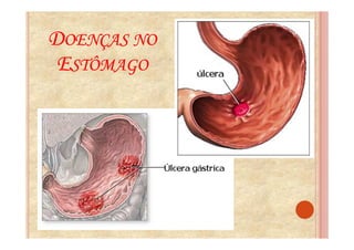 DOENÇAS NO
 ESTÔMAGO
 