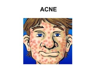 ACNE
 