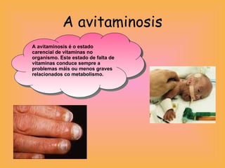A avitaminosis A avitaminosis é o estado carencial de vitaminas no organismo. Este estado de falta de vitaminas conduce sempre a problemas máis ou menos graves relacionados co metabolismo. 