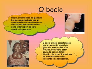 O bocio Bocio, enfermidade da glándula tiroides caracterizada por un aumento do seu tamaño que se visualiza externamente como unha inflamación na cara anterior do pescozo.   O bocio simple caracterízase por un aumento global da glándula, ou dun das súas lóbulos, que adoita estar causado por un déficit dietético de yodo. A aparición da enfermidade é máis frecuente en adolescentes. 1 2 3 