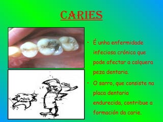 Caries É unha enfermidade infeciosa crónica que pode afectar a calquera peza dentaria.  O sarro, que consiste na placa dentaria endurecida, contribue a formación da carie. 