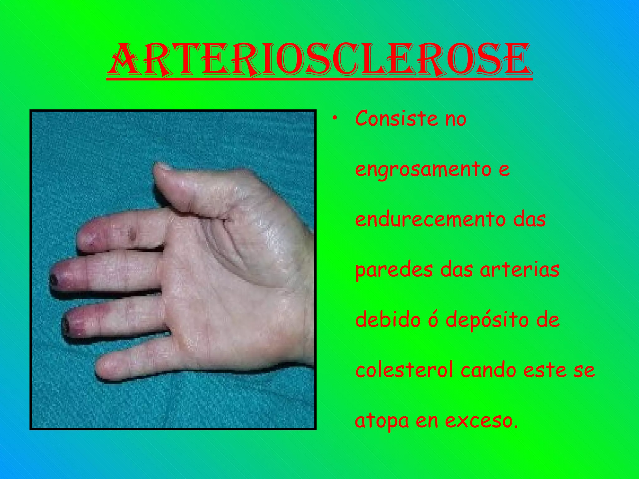 Arteriosclerose Consiste no engrosamento e endurecemento das paredes das arterias debido ó depósito de colesterol cando este se atopa en exceso.   