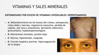 VITAMINAS Y SALES MINERALES
ENFERMEDADES POR EXCESO DE VITAMINAS LIPOSOLUBLES: HIPERVITAMINOSIS
▶ A: Reblandecimiento de los huesos del cráneo, osteoporosis,
visión doble y borrosa, impotencia masculina, pérdida de
cabello, piel seca y amarillenta, dermatitis seborreica,
ginecomastia, hepatoesplenomegalia.
▶ D: Alteraciones mentales, presión baja.
▶ E: Diarrea, hipertensión, sangrado.
▶ K: Función hepática anormal, hipercoagulación
de la sangre.
 