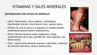 VITAMINAS Y SALES MINERALES
ENFERMEDADES POR EXCESO DE MINERALES
▶ Calcio: Pancreatitis, úlcera péptica, nefrolitiasis,
hipertensión arterial, insuficiencia renal, quistes óseos.
▶ Fósforo: Se une al calcio y se deposita en tejidos blandos
produciendo quistes óseos e hipocalcemia.
▶ Hierro: Hemocromatosis (dolor abdominal, fatiga,
oscurecimiento de la piel, pérdida del vello corporal y del
deseo sexual.
▶ Flúor: alteraciones dentales (porosos y delicados, cubiertos
de manchas marrones, caries y destrucción).
 