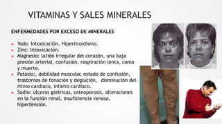 VITAMINAS Y SALES MINERALES
ENFERMEDADES POR EXCESO DE MINERALES
▶ Yodo: Intoxicación, Hipertiroidismo.
▶ Zinc: Intoxicación.
▶ Magnesio: latido irregular del corazón, una baja
presión arterial, confusión, respiración lenta, coma
y muerte.
▶ Potasio:, debilidad muscular, estado de confusión,
trastornos de fonación y deglución, disminución del
ritmo cardiaco, infarto cardiaco.
▶ Sodio: úlceras gástricas, osteoporosis, alteraciones
en la función renal, insuficiencia venosa,
hipertensión.
 