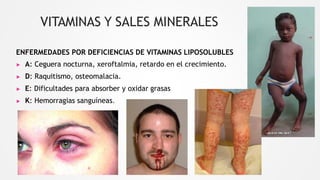 VITAMINAS Y SALES MINERALES
ENFERMEDADES POR DEFICIENCIAS DE VITAMINAS LIPOSOLUBLES
▶ A: Ceguera nocturna, xeroftalmia, retardo en el crecimiento.
▶ D: Raquitismo, osteomalacia.
▶ E: Dificultades para absorber y oxidar grasas
▶ K: Hemorragias sanguíneas.
 