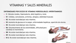 VITAMINAS Y SALES MINERALES
ENFERMEDADES POR EXCESO DE VITAMINAS HIDROSOLUBLES: HIPERVITAMINOSIS
▶ C: Cálculos renales, hiperoxaluria, daño hepático y renal.
▶ B1: Cefalea, convulsiones, arritmias, alergias y debilidad muscular.
▶ B2: No existe toxicidad por esta vitamina.
▶ B3: Aumento de glucosa en la sangre, enfermedades hepáticas, aparición de ulceras.
▶ B5: No existe toxicidad por esta vitamina.
▶ B6: Entumecimiento de las extremidades, dificultad para
coordinar el movimiento.
▶ B8: No existe toxicidad por esta vitamina.
▶ B9: No existe toxicidad por esta vitamina.
▶ B12: No existe toxicidad por esta vitamina.
 
