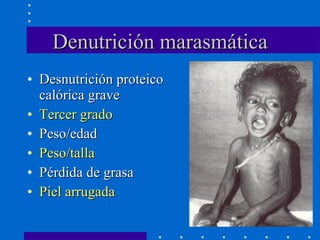 Denutrición marasmática Desnutrición proteico calórica grave Tercer grado Peso/edad Peso/talla Pérdida de grasa Piel arrugada 