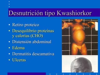 Desnutrición tipo Kwashiorkor Retiro proteico Desequilibrio proteínas y calorías (CHO) Distensión abdominal Edema  Dermatitis descamativa Ulceras 