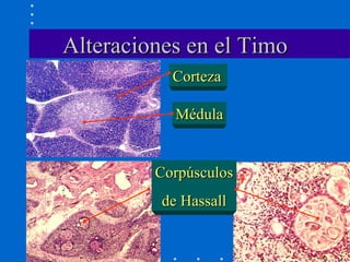 Alteraciones en el Timo Corteza Médula Corpúsculos de Hassall 