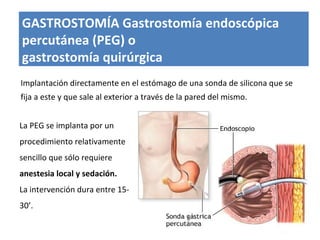 La PEG se implanta por un
procedimiento relativamente
sencillo que sólo requiere
anestesia local y sedación.
La intervención dura entre 15-
30’.
GASTROSTOMÍA Gastrostomía endoscópica
percutánea (PEG) o
gastrostomía quirúrgica
Implantación directamente en el estómago de una sonda de silicona que se
fija a este y que sale al exterior a través de la pared del mismo.
 