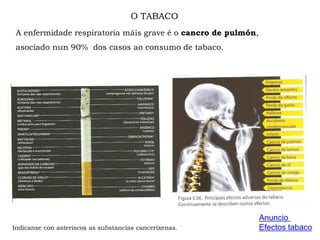 O TABACO
A enfermidade respiratoria máis grave é o cancro de pulmón,
asociado nun 90% dos casos ao consumo de tabaco.
Anuncio
Efectos tabacoIndícanse con asteriscos as substancias canceríxenas.
 