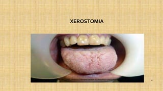 XEROSTOMIA
SERVICIO DE ENFERMERIA : MIRKO PALLUMBO , FRANCISCO BRASERO ORTEGA /// RESIDENCIA SANTA MARIA DEL
MONTECARMELO
16
 