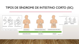 Fall Intestinal NUTRICIÓN EN FALLA INTESTINAL medicina | PDF