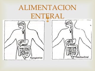 
ALIMENTACION
ENTERAL
 