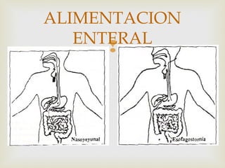 
ALIMENTACION
ENTERAL
 