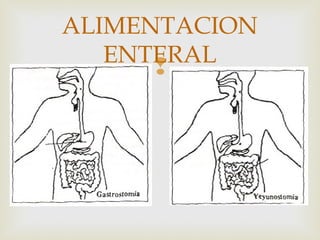 
ALIMENTACION
ENTERAL
 