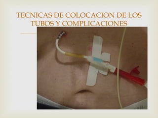 
TECNICAS DE COLOCACION DE LOS
TUBOS Y COMPLICACIONES
 