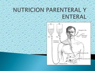NUTRICION PARENTERAL Y ENTERAL<br />