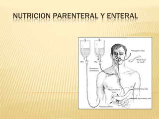 NUTRICION PARENTERAL Y ENTERAL

 
