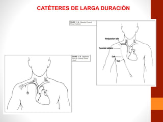CATÉTERES DE LARGA DURACIÓN
 