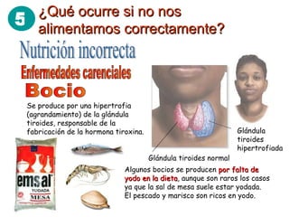 5 ¿Qué ocurre si no nos¿Qué ocurre si no nos
alimentamos correctamente?alimentamos correctamente?
Glándula
tiroides
hipertrofiada
Glándula tiroides normal
Se produce por una hipertrofia
(agrandamiento) de la glándula
tiroides, responsable de la
fabricación de la hormona tiroxina.
Algunos bocios se producen por falta depor falta de
yodo en la dietayodo en la dieta, aunque son raros los casos
ya que la sal de mesa suele estar yodada.
El pescado y marisco son ricos en yodo.
 
