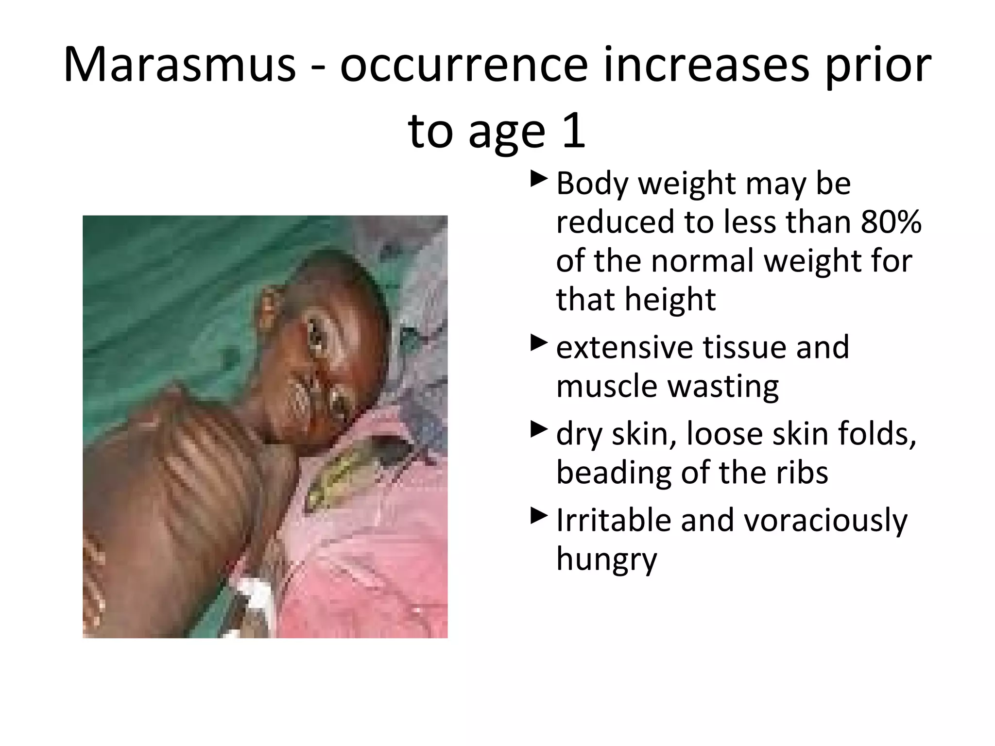 Marasmus - occurrence increases prior
to age 1
Body weight may be
reduced to less than 80%
of the normal weight for
that height
extensive tissue and
muscle wasting
dry skin, loose skin folds,
beading of the ribs
Irritable and voraciously
hungry
 