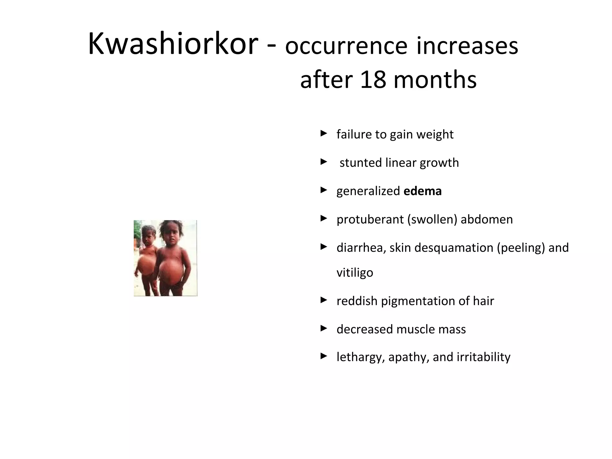 Kwashiorkor - occurrence increases
after 18 months
 failure to gain weight
 stunted linear growth
 generalized edema
 protuberant (swollen) abdomen
 diarrhea, skin desquamation (peeling) and
vitiligo
 reddish pigmentation of hair
 decreased muscle mass
 lethargy, apathy, and irritability
 