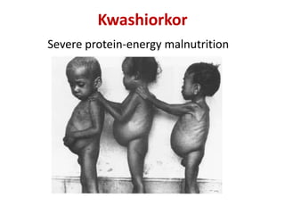 Kwashiorkor
Severe protein-energy malnutrition
 