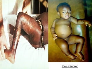 Kwashiorkor
 