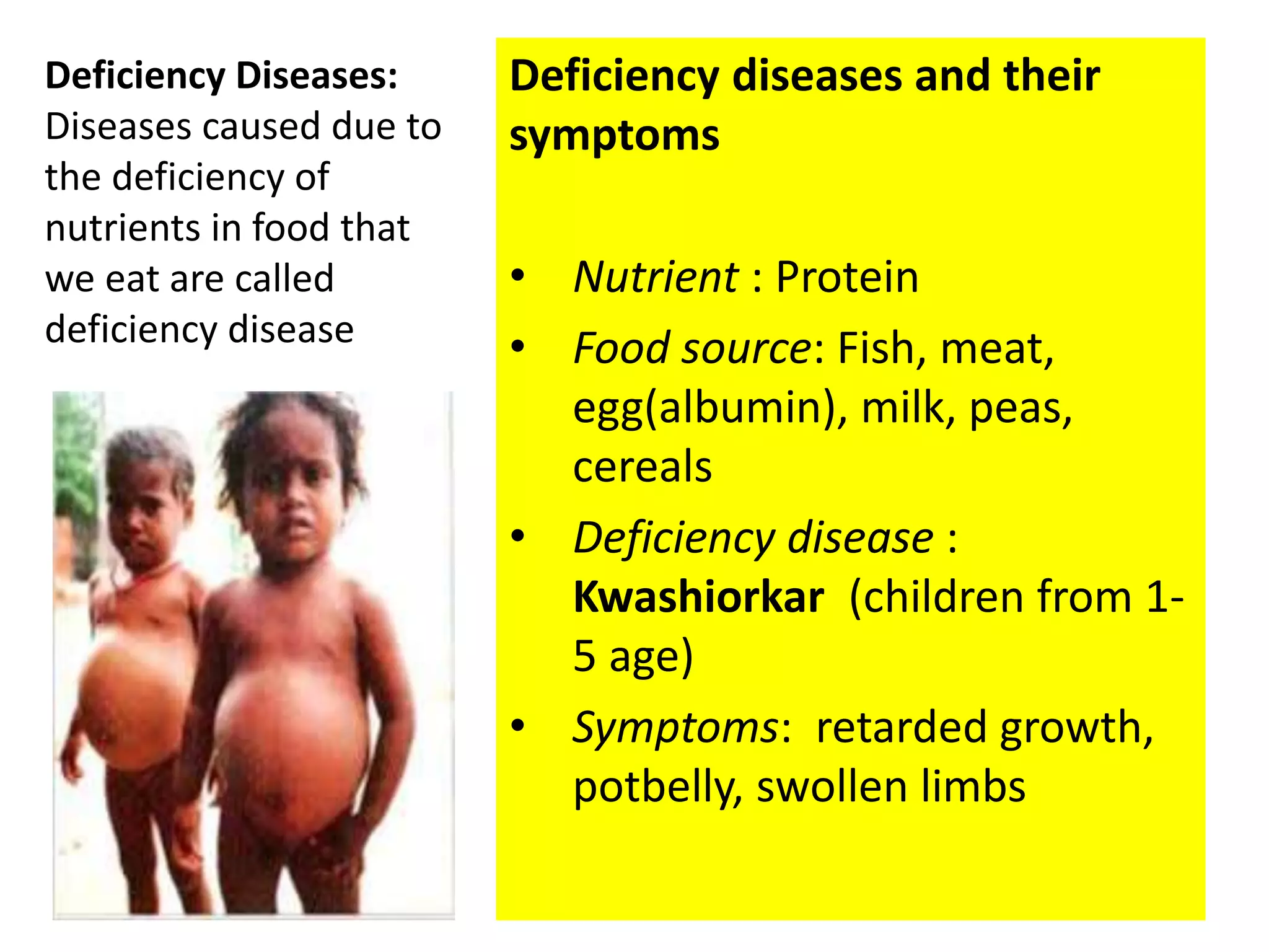 Deficiency Image Example Nutrients & Deficiency disease | PPTX
