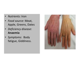Nutrients & Deficiency disease | PPTX